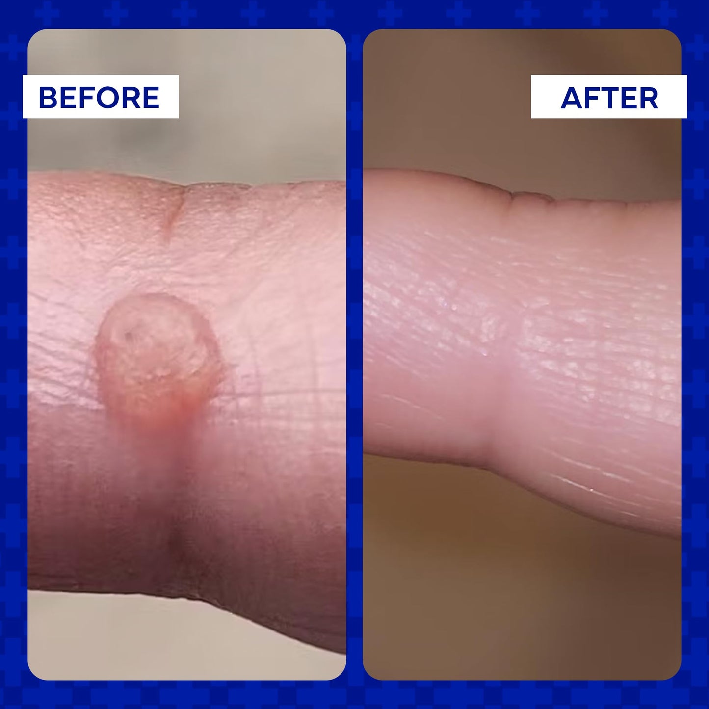 EMUAID Ointment for Eczema & Psoriasis Relief | Steroid-Free, All Ages, 2oz