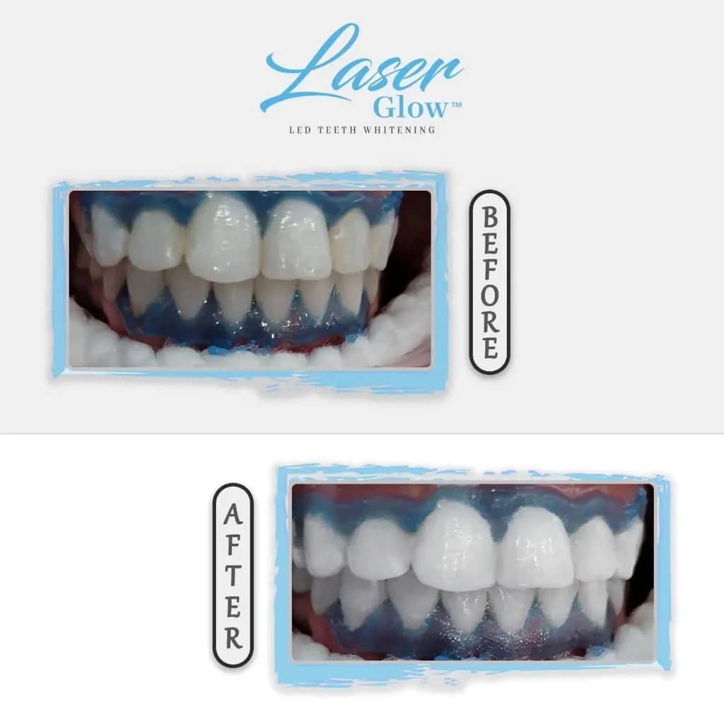 LaserGlow Professional Teeth Whitening Gel 44% Hydrogen Peroxide – Dual Barrel Syringe