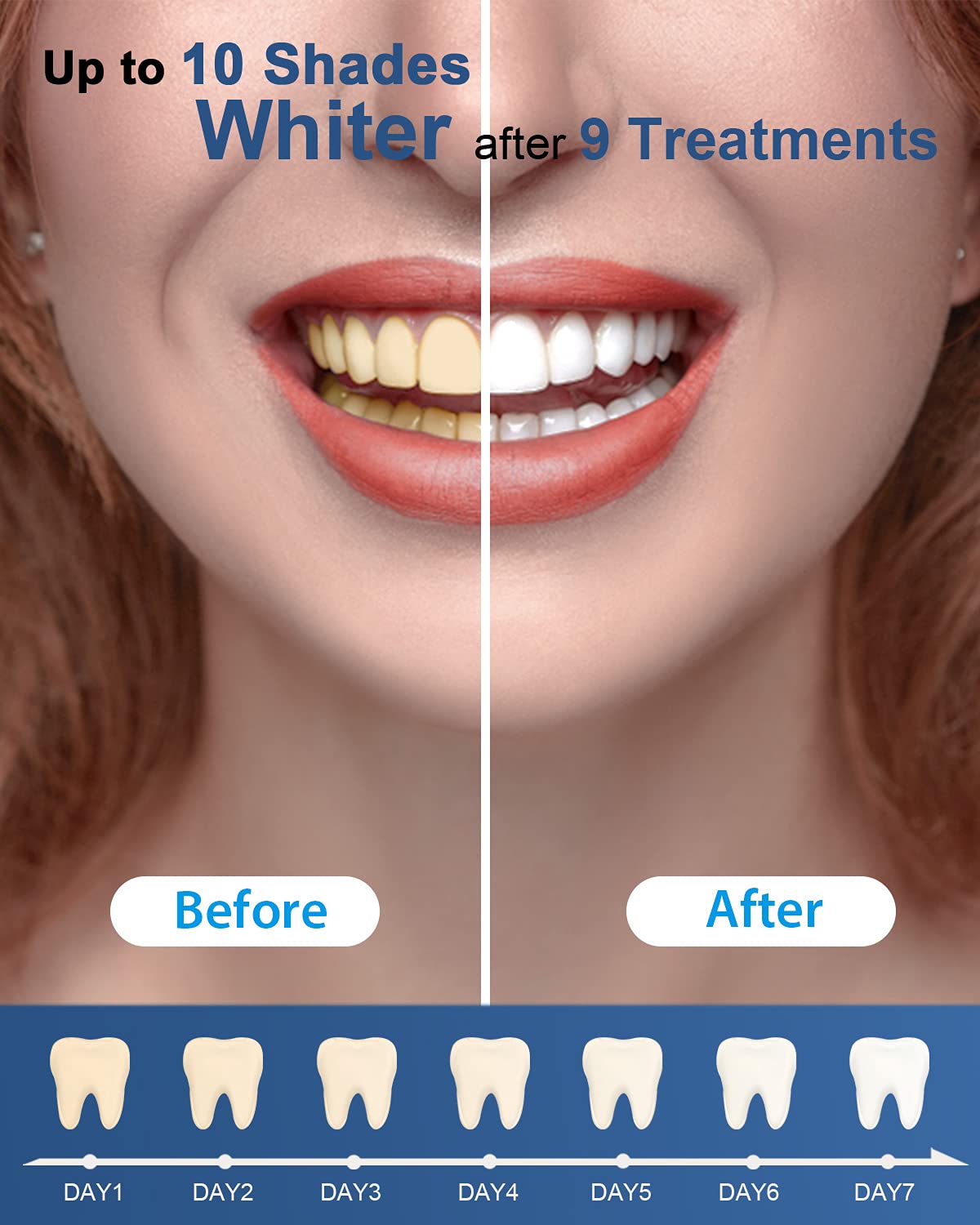 MySmile Teeth Whitening Gel Refills Pack – 6 Non-Sensitive, 10-Min Whitening