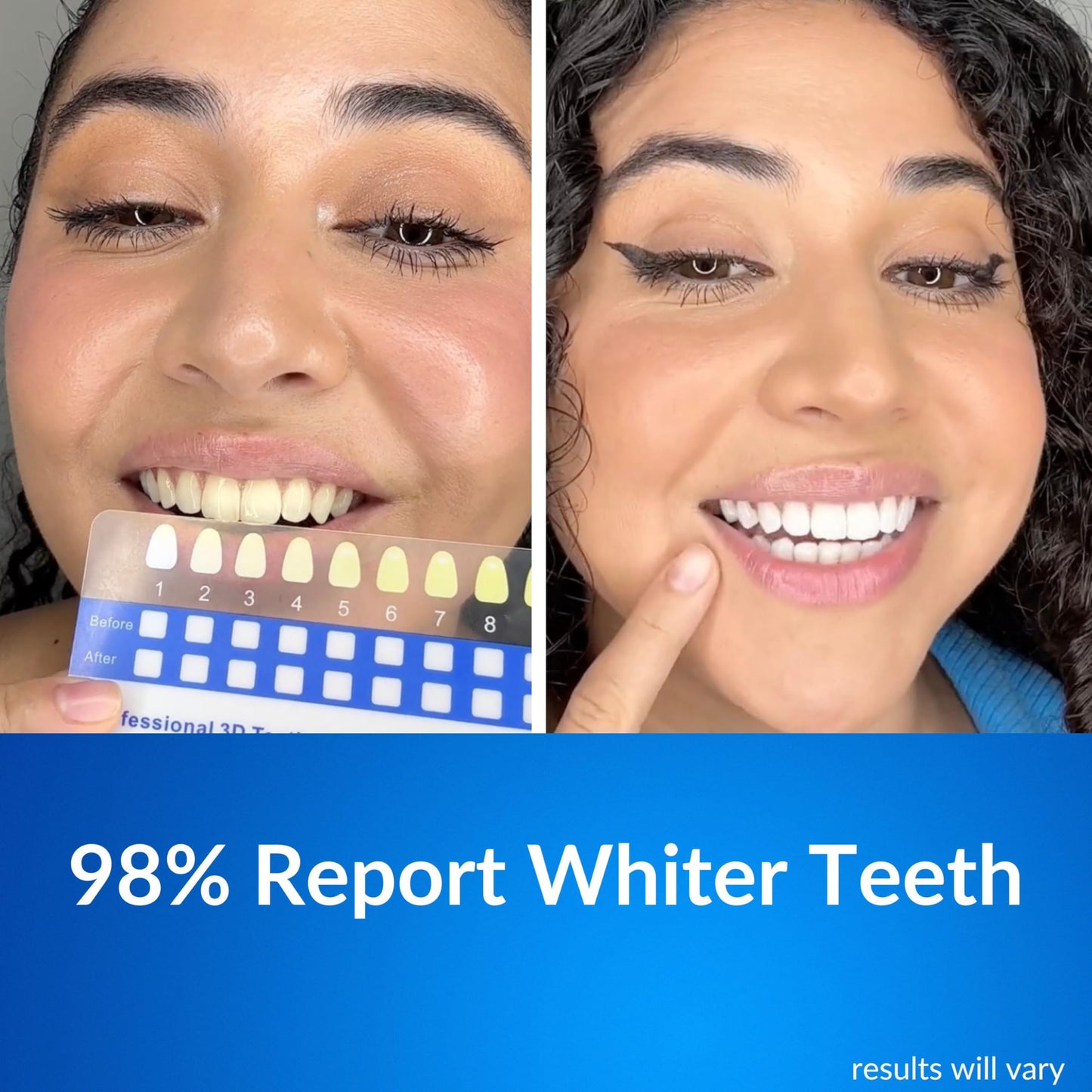 Polar MD Teeth Whitening Kit – 1 Year Supply, 60 Treatments, Gel Pens, 32 LED Light