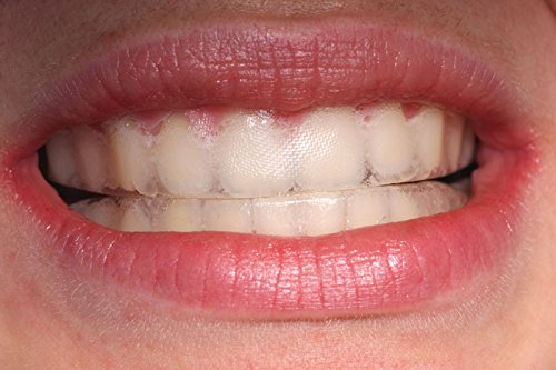 Teeth Whitening Tray Ultra White – 0.75mm Ultra Thin Moldable Trays with Storage Case