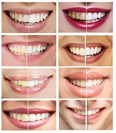 White Teeth Global 10 Syringes (3ml) - New Strongest 44% Carbamide Peroxide Teeth Whitening Gel (Mouth Trays NOT Included)