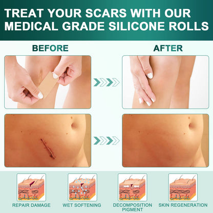 AirroYE Silicone Scar Sheets Roll 1.6x120 - Reusable Scar Tape for Surgical Scars, Keloids, C-Section & Burns