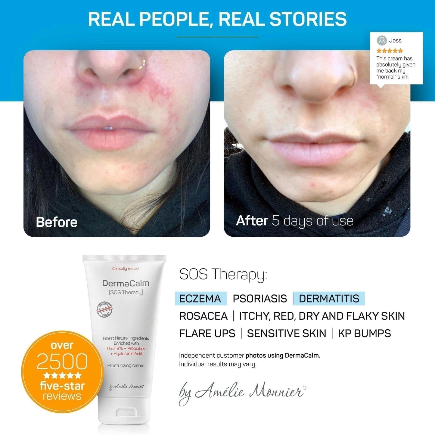 Amélie Monnier Clinically Tested DermaCalm SOS Therapy – Eczema & Dry Skin with Urea 8%, Probiotics