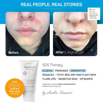 Amélie Monnier Clinically Tested DermaCalm SOS Therapy – Eczema & Dry Skin with Urea 8%, Probiotics
