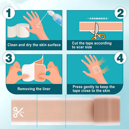 Arme Silicone Scar Tape Roll (1.6x180) – Medical-Grade Scar Sheets for Surgical Scars
