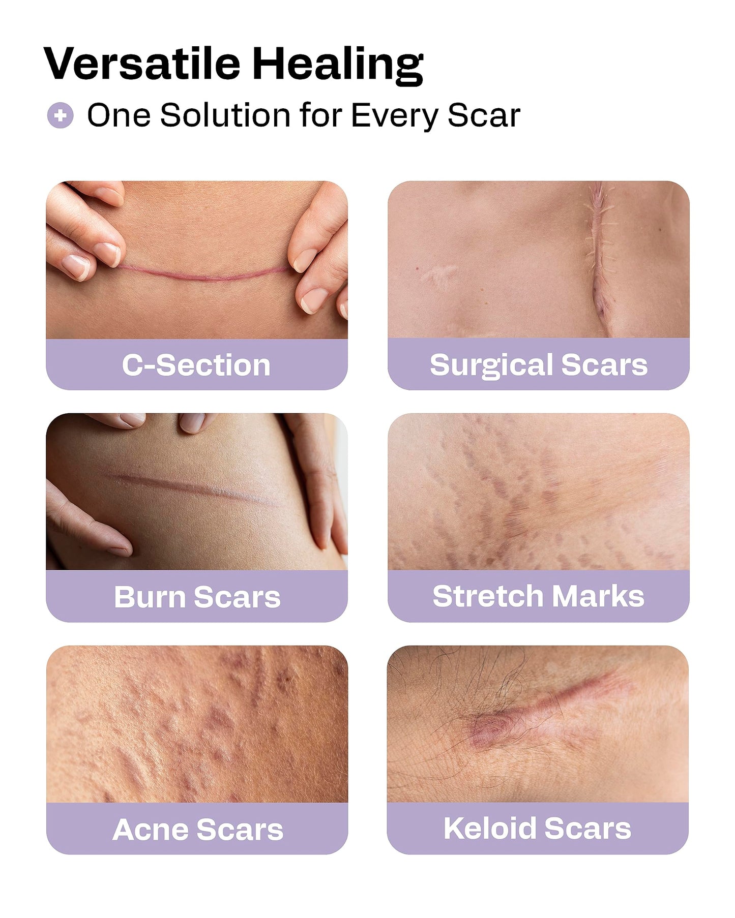 AWD Silicone Scar Tape 3 Pack – 180in Total, Reusable for Surgery & Postpartum | AWD Medical