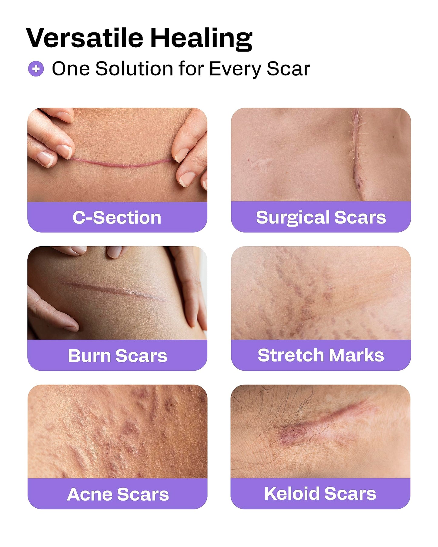 AWD Medical Silicone Scar Tape 120in Roll – Medical Grade Scar Sheets for Surgical, C-Section & Postpartum Recovery