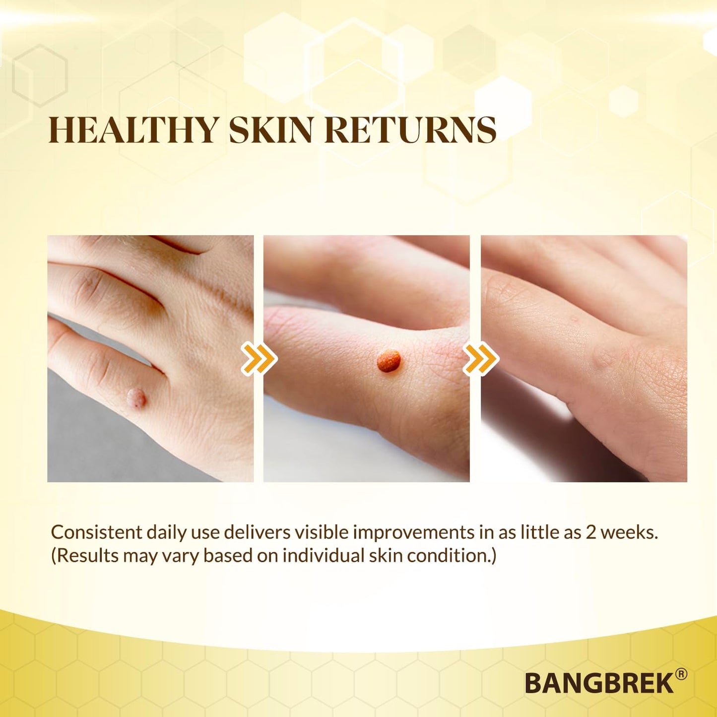 Bangbrek Bee Venom Wart Remover — 17% Salicylic Acid Fast-Acting Wart & Callus Remover (1 fl oz)