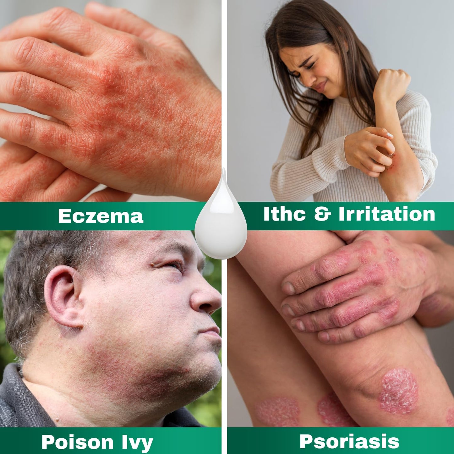 Barmicil Plus Cream 1% Hydrocortisone – Itch Relief for Skin Allergies with Aloe Vera