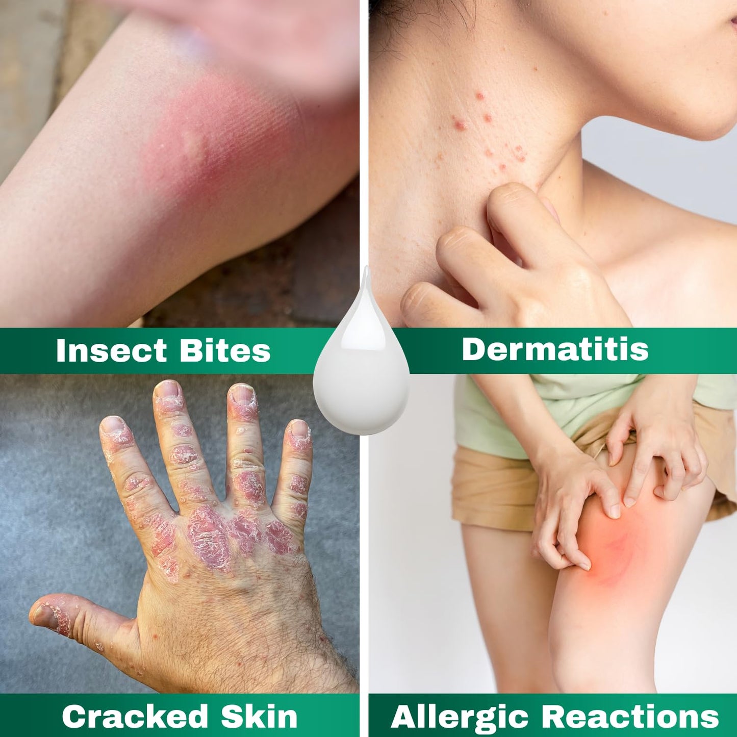 Barmicil Plus Cream 1% Hydrocortisone – Itch Relief for Skin Allergies with Aloe Vera