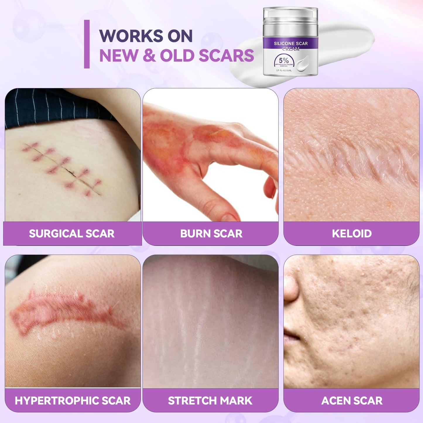 BAUTVAS Advanced Scar Cream – Silicone Scar Gel for Surgical Scars, Stretch Marks & Keloids (1.7 oz)