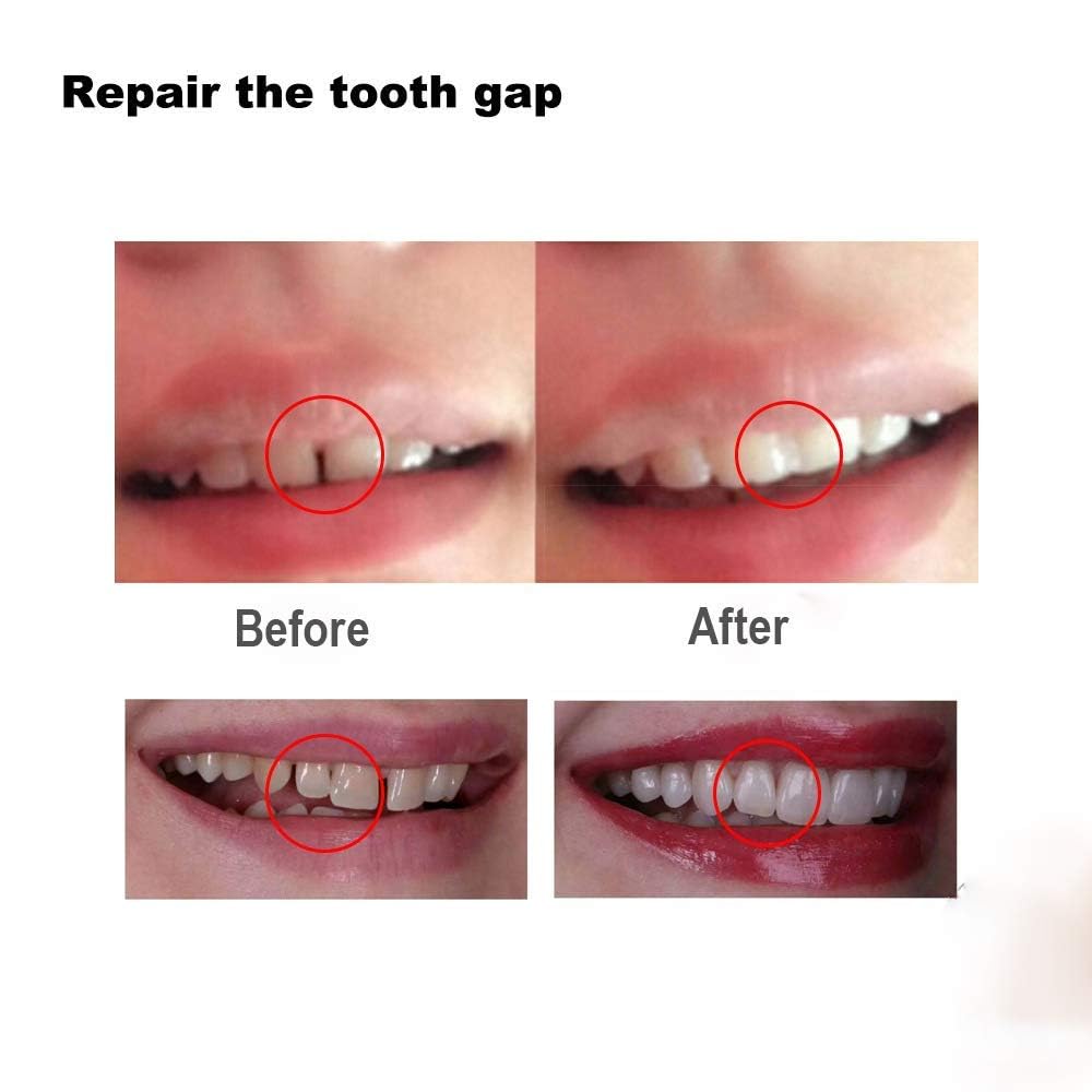 Tooth Filling Thermal Beads – DIY Moldable Temporary Teeth Repair Kit (2 Pack)