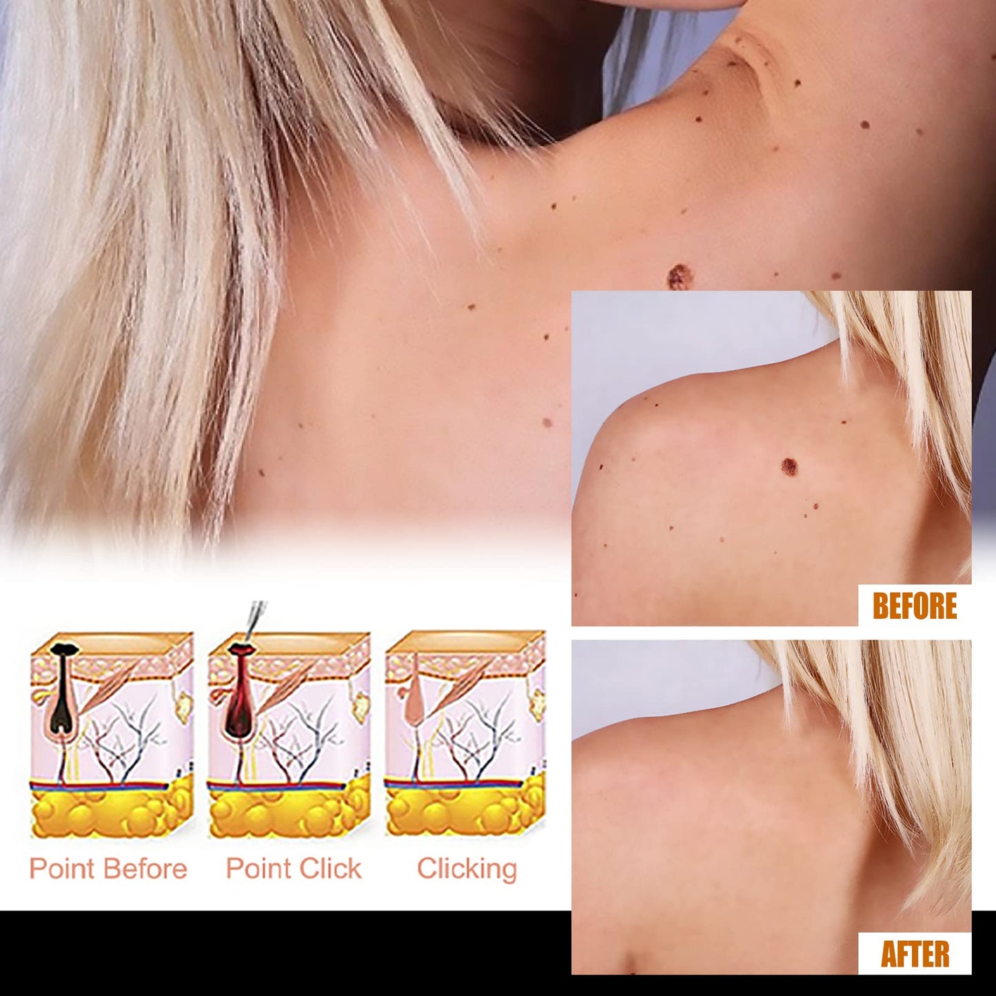 Befada Skin Mole Remover for Face & Body – Precision Dropper Serum, Fast-Acting Wart & Mole Care (10ML)