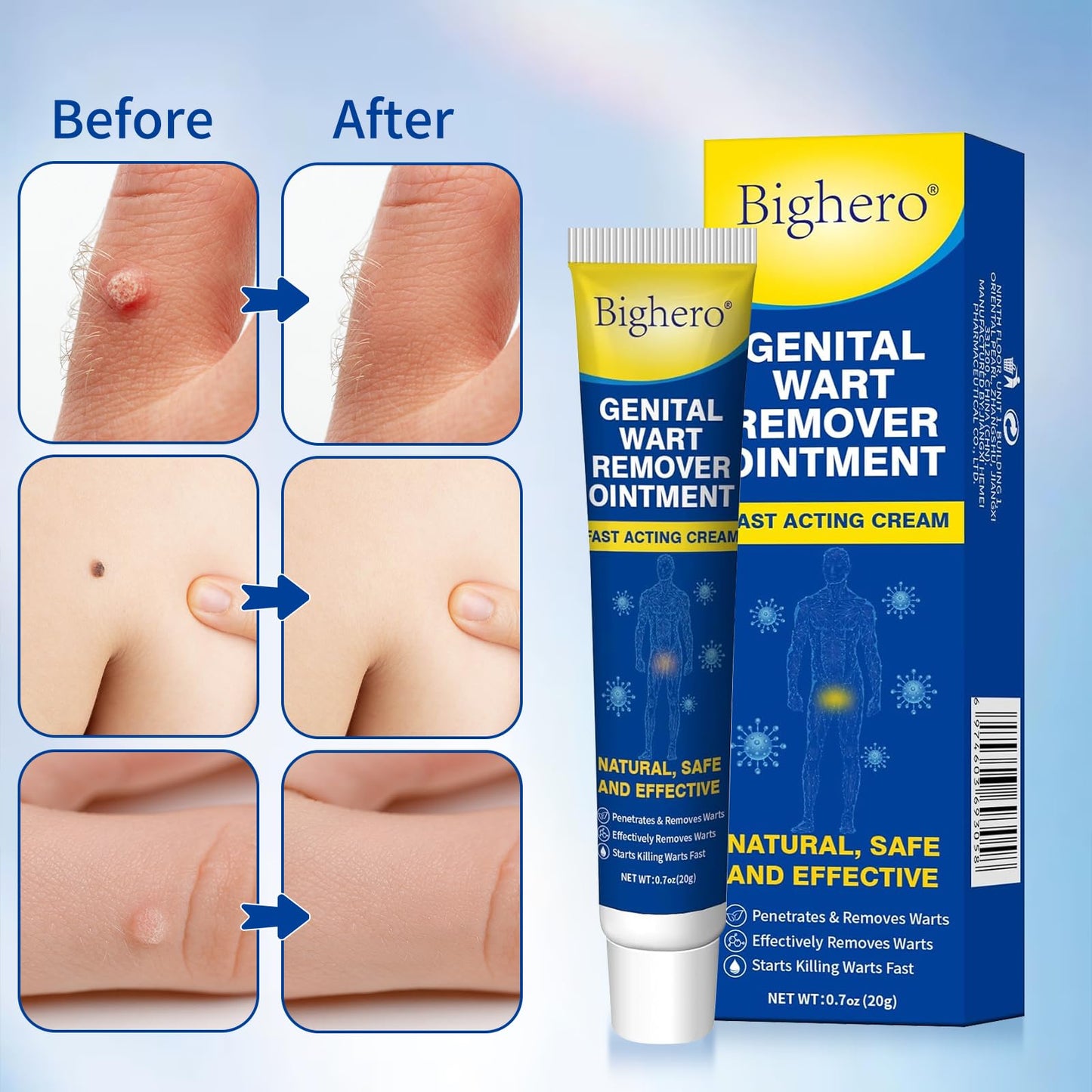 Bighero 2-Pack Wart Fast Acting Gel – Genital Warts, Plantar Warts, Common Warts & Corn