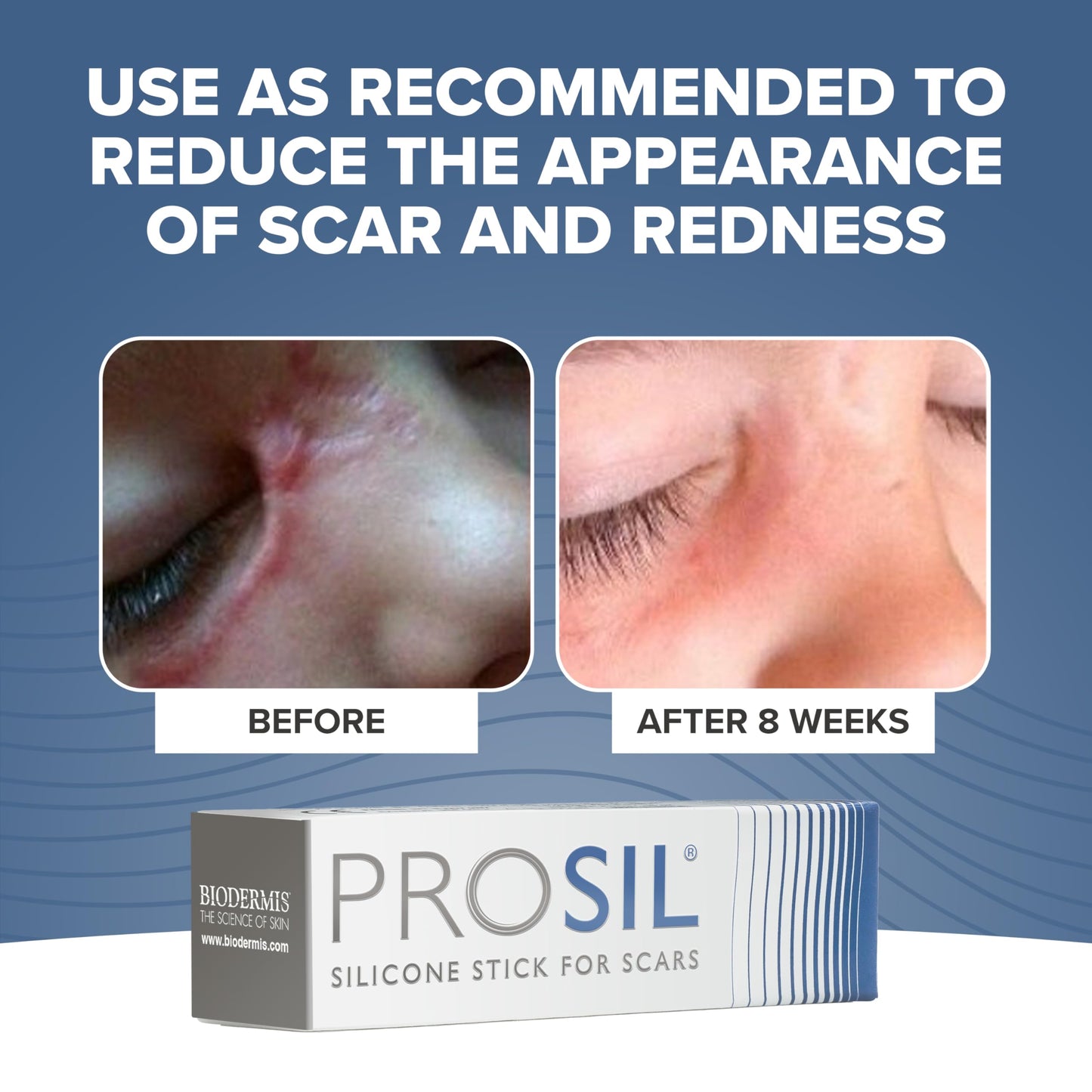 BIODERMIS ProSIL Silicone Scar Stick – Non-Invasive Scar Gel for Surgical, Acne & Burn Scars (17g)