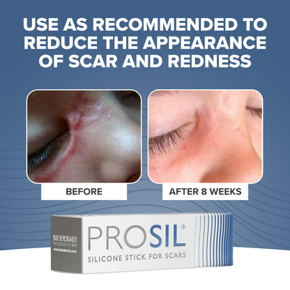 BIODERMIS ProSIL Silicone Scar Stick – Non-Invasive Scar Gel for Surgical, Acne & Burn Scars (17g)