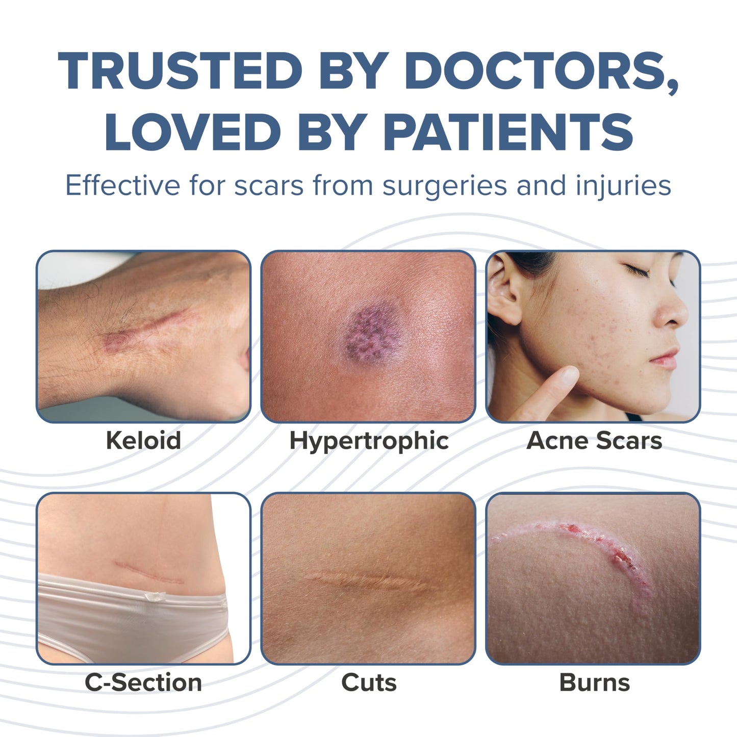 BIODERMIS PROSIL Silicone Scar Stick 4.25g | Glide-On, Mess-Free Scar Care
