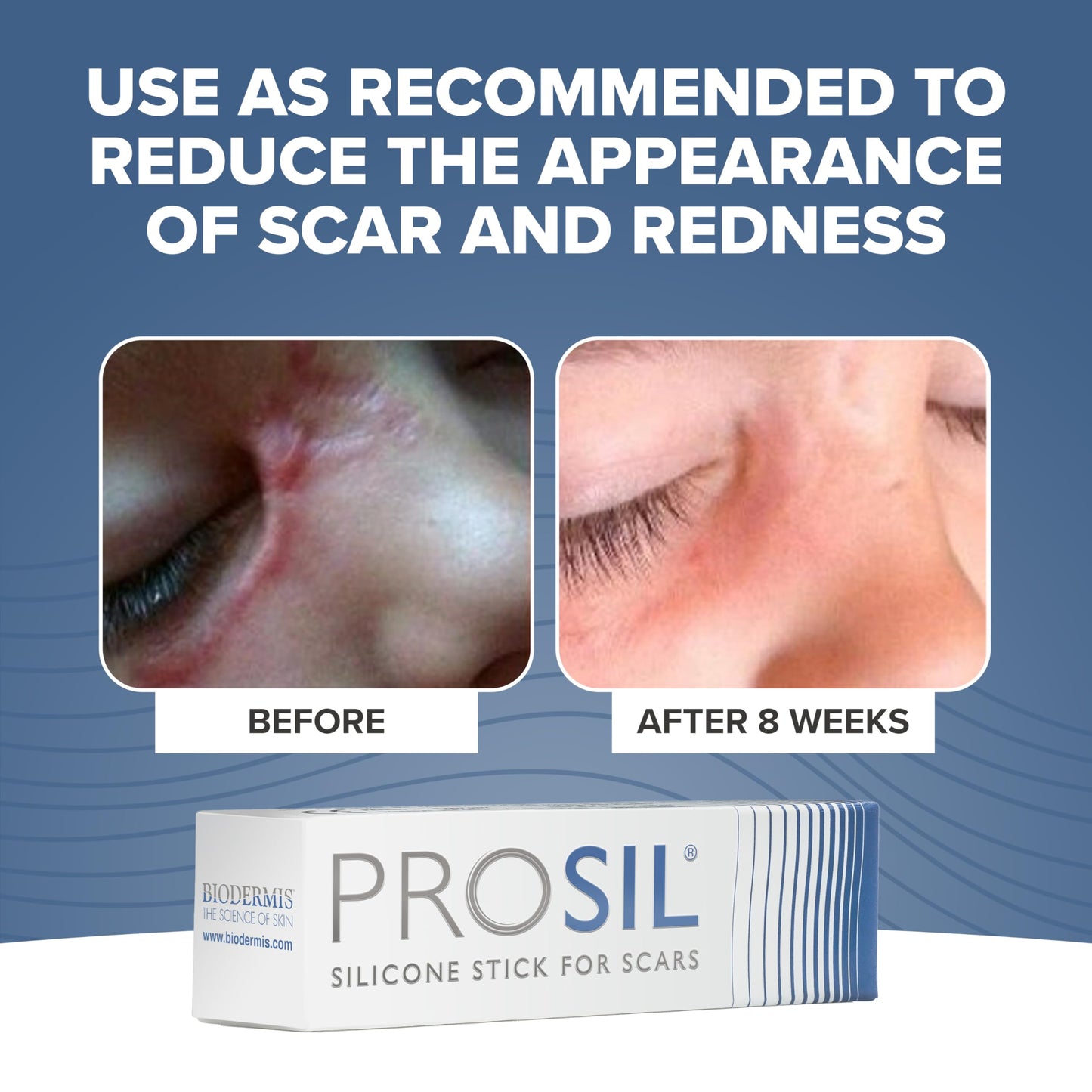 BIODERMIS PROSIL Silicone Scar Stick 4.25g | Glide-On, Mess-Free Scar Care