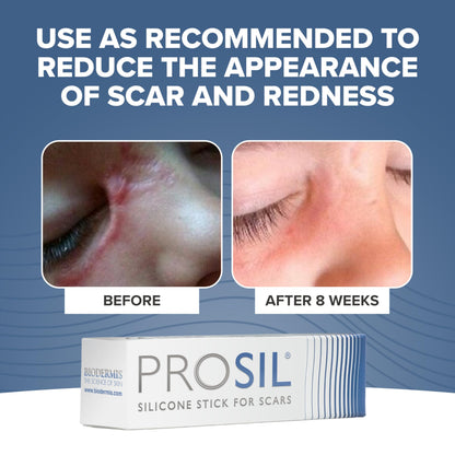 BIODERMIS PROSIL Silicone Scar Stick 4.25g | Glide-On, Mess-Free Scar Care