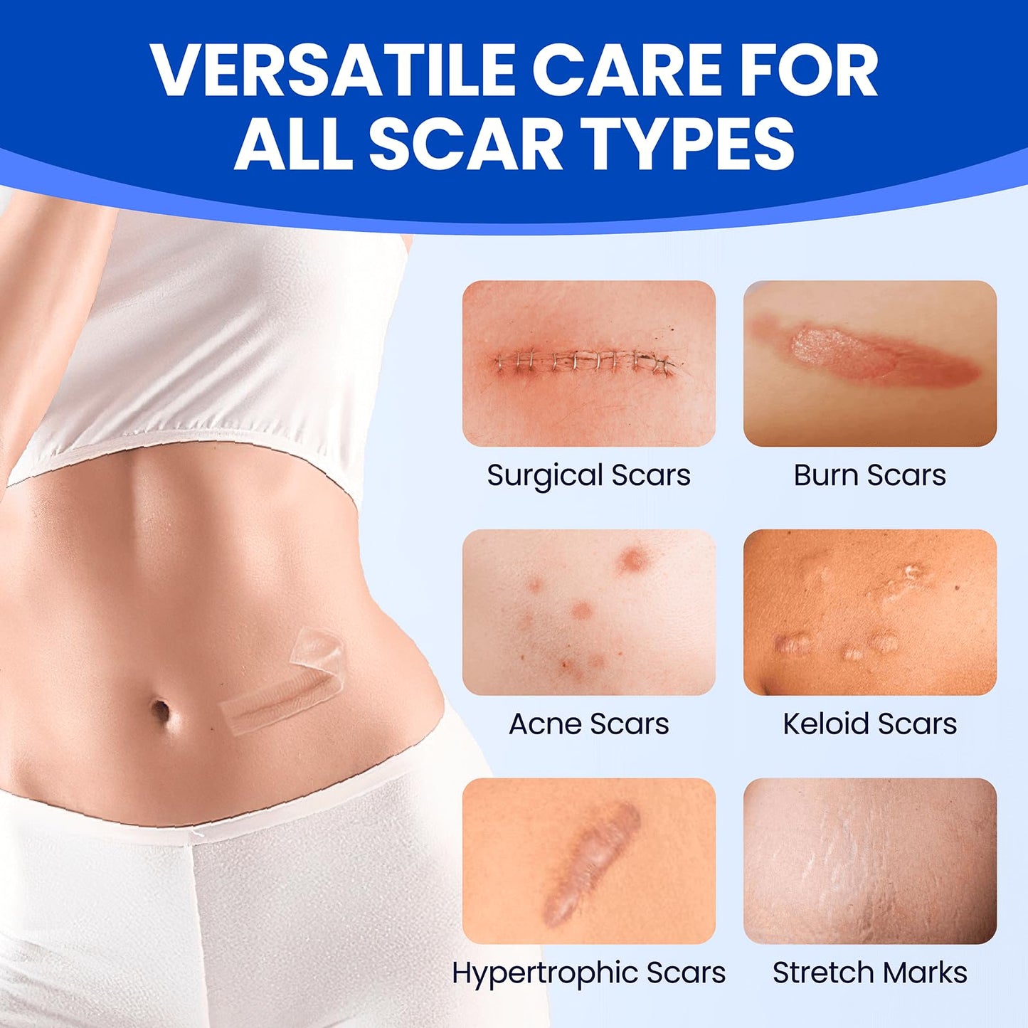 Bioemmalab Silicone Scar Sheets - Medical Grade Tape Roll (1.6" x 150") for Post-Surgical, Acne & Keloid Scars