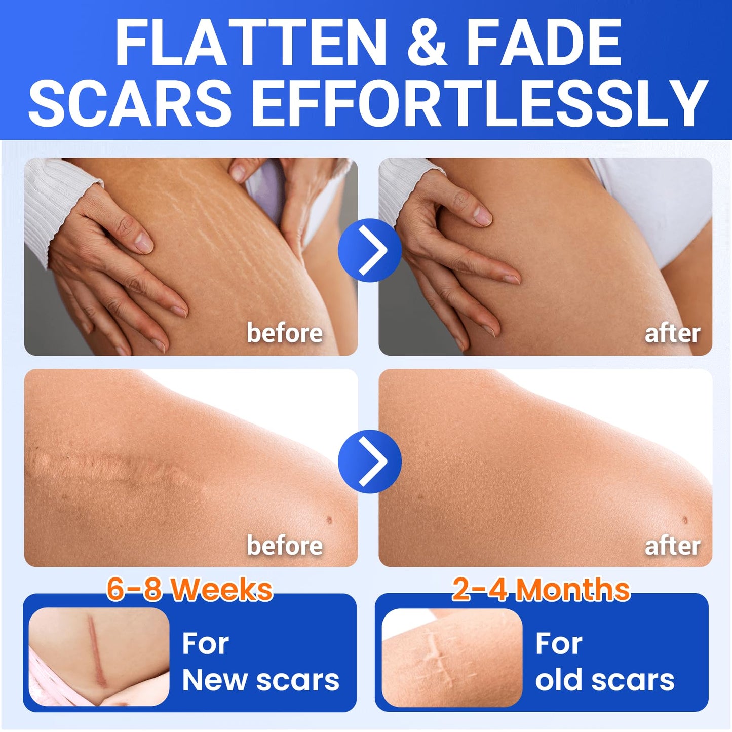 Bioemmalab Silicone Scar Sheets - Medical Grade Tape Roll (1.6" x 150") for Post-Surgical, Acne & Keloid Scars