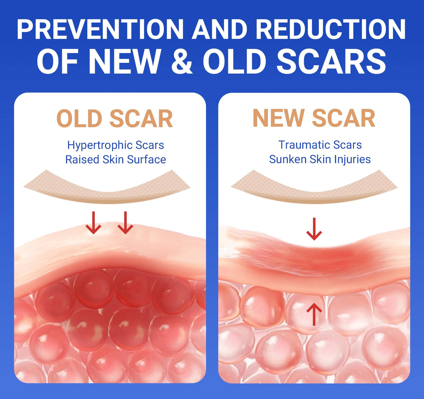 Bioemmalab Silicone Scar Sheets - Medical Grade Tape Roll (1.6" x 150") for Post-Surgical, Acne & Keloid Scars