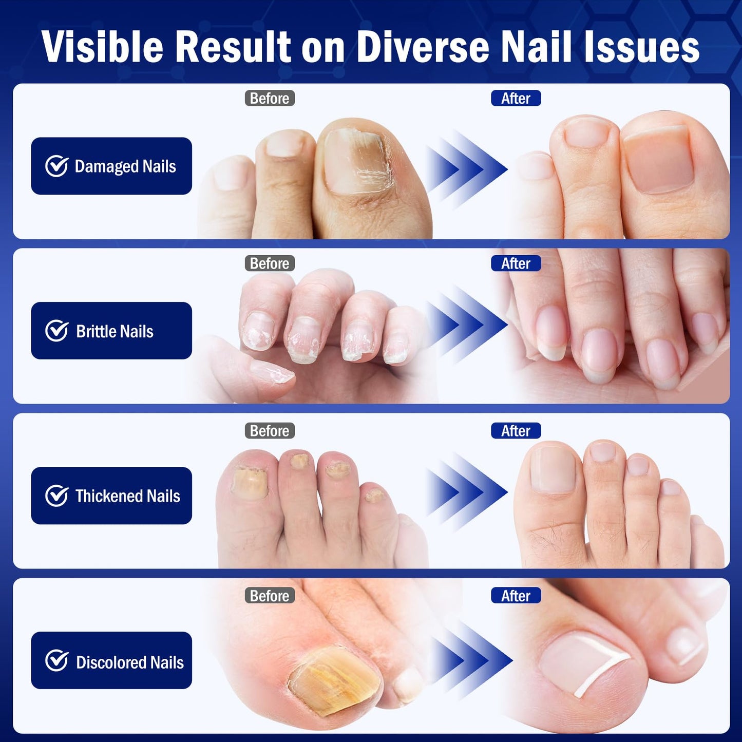 Bldaxn Toe Nail Fungus Renewal – Fast Acting 1 Pack for Thick, Discolored Nails