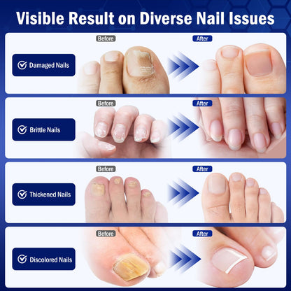 Bldaxn Toe Nail Fungus Renewal – Fast Acting 1 Pack for Thick, Discolored Nails