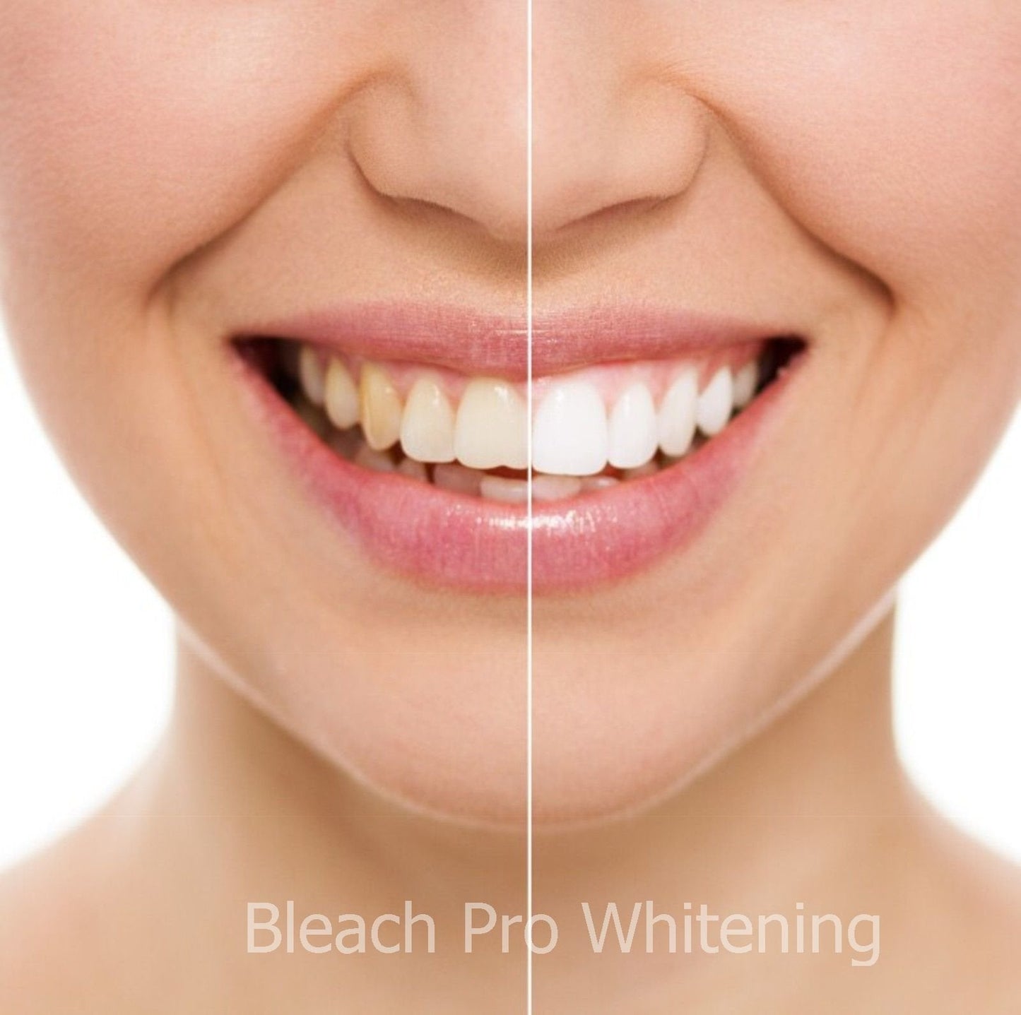 Teeth Whitening Gel Syringe Dispensers – 22% Carbamide Peroxide, 10 x 3ml Syringes