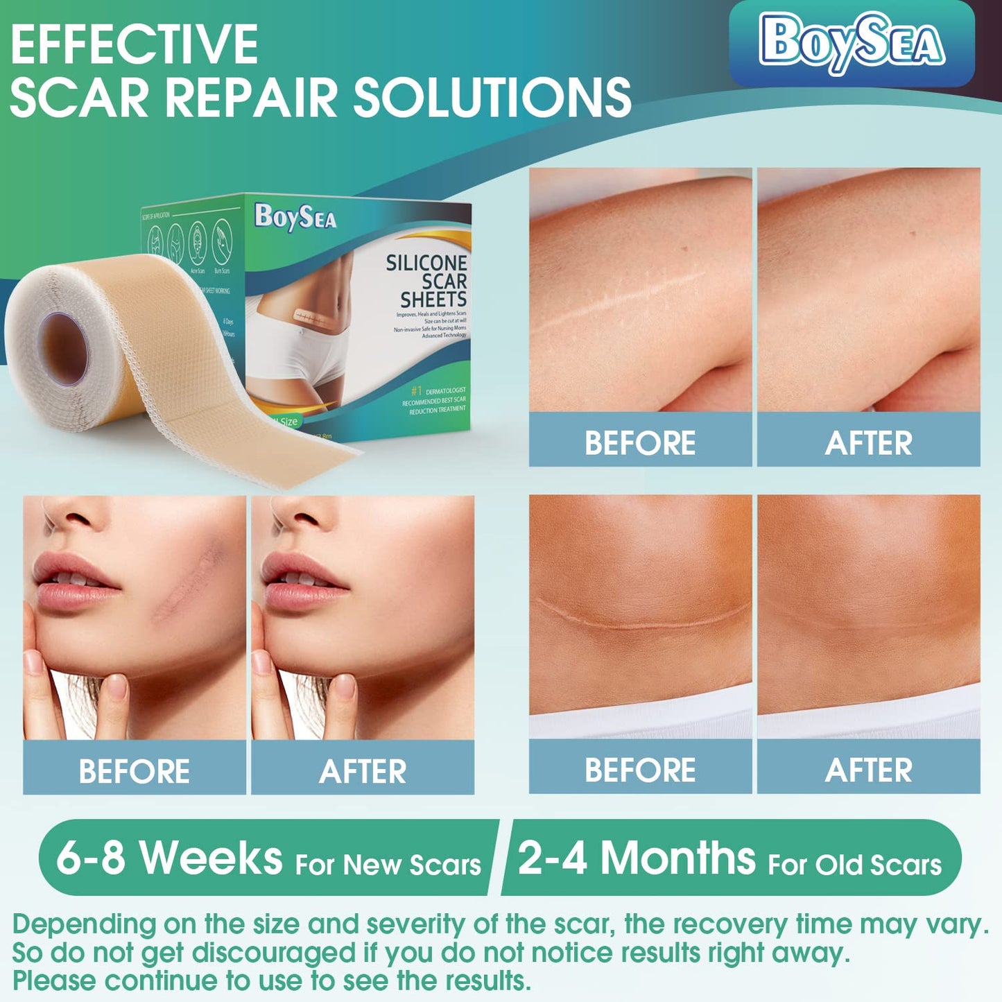Boysea Professional Silicone Scar Sheets Roll 1.6x150 in | Reusable Scar Tape for Keloid, C-Section, Surgery, Burn & Acne