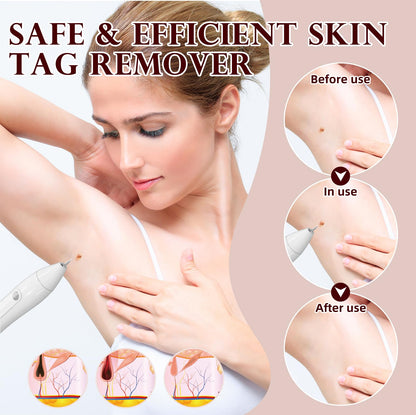 Breaspec LM 1000 SkinTag Remover - At-Home Wart & Skin Tag Kit