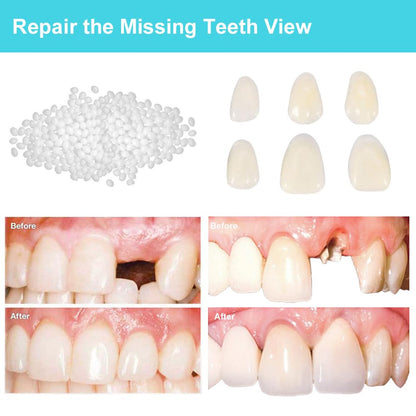Brige Tooth Repair kit for Filling The Missing Broken Tooth and Gaps-Moldable Fake Teeth and Thermal Beads Replacement Kit