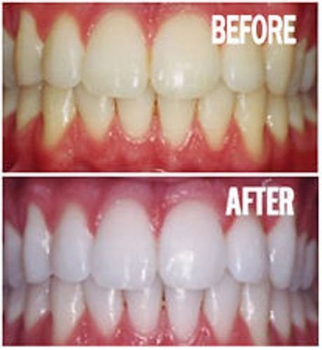 Bright White Smiles Teeth Whitening Gel Refill Kit - 10 Tubes, 44% Carbamide Peroxide