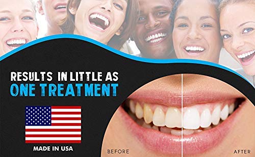 Bright White Smiles Teeth Whitening Kit – 35% Carbamide Peroxide Gel, 5x 5cc Refills