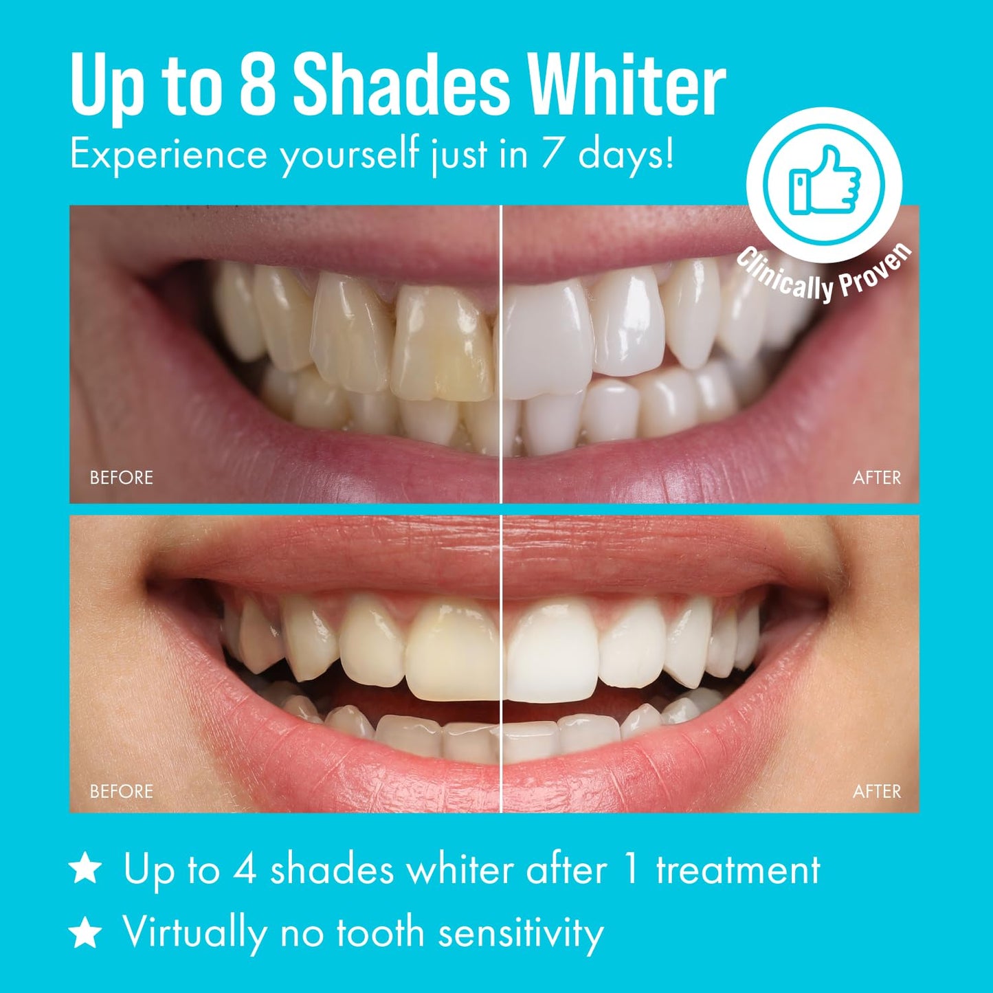 Cali White Teeth Whitening Kit with LED Light – 2x5ml Syringes & Trays