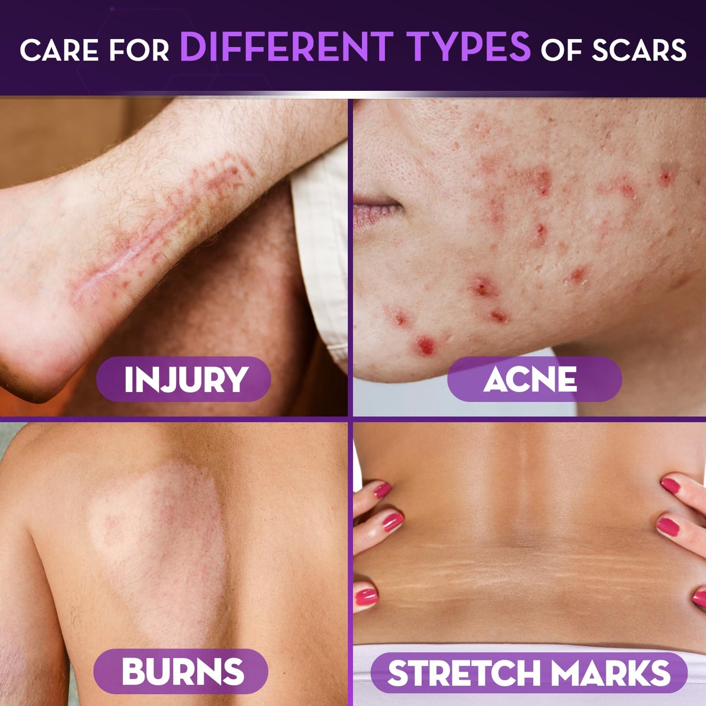 Cicatricure Advanced Scar Gel for Face & Body - Visible Results in 2 Weeks | Scar Treatment for Surgical, Acne, Burns, Stretch Marks | Pack of 2