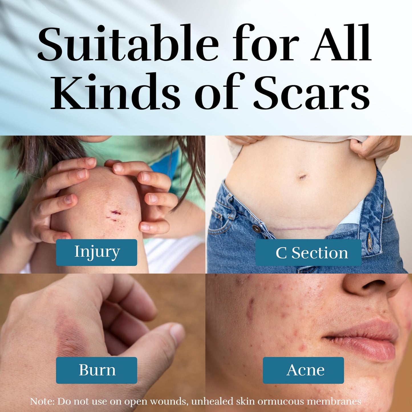 CLNABFR Advanced Scar Cream - Silicone Scar Treatment for Postoperative, Burns & Acne Scars, 1.76 oz