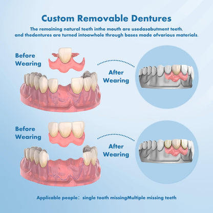 Custom Removable Dentures – Personalized Partial Denture Set for Tooth Replacement | 1–Multi-Tooth Coverage with Storage Case | Comfortable Wear