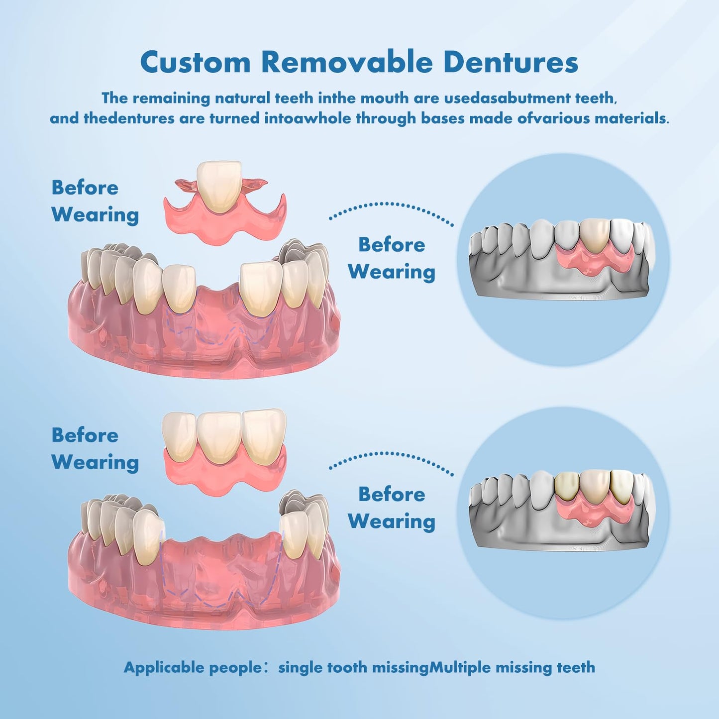 Custom Removable Dentures – Personalized Partial Denture Set | 1–6 Teeth