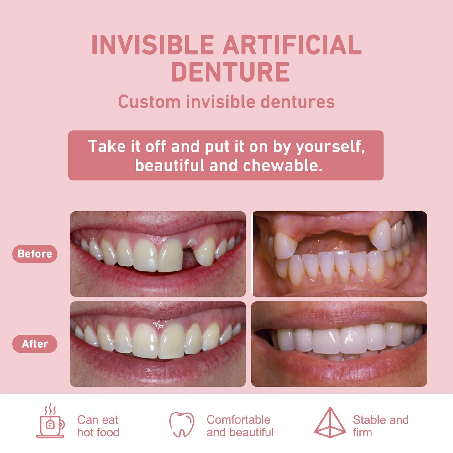 Custom Partial Dentures – Personalized Removable Denture Set for Missing Teeth | 1–6 Tooth Replacement with Storage Case | Natural Look & Comfortable Fit
