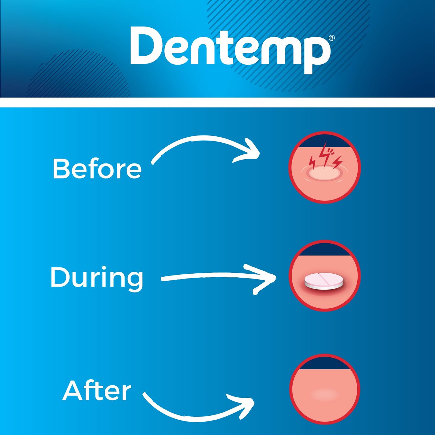 Dentemp Canker Cover 2pk – Canker Sore Medicine & Pain Relief (12 Count) for Adults