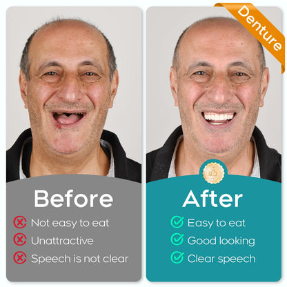 DIY Dentures Kit - Create Your Smile at Home | Temporary Denture Kit