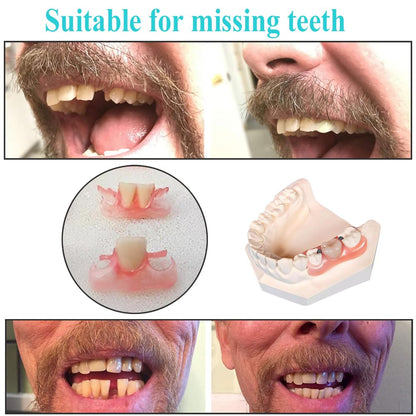 Dentures DIY Kit – Easy At-Home Temporary Teeth Replacement (Full or Partial)