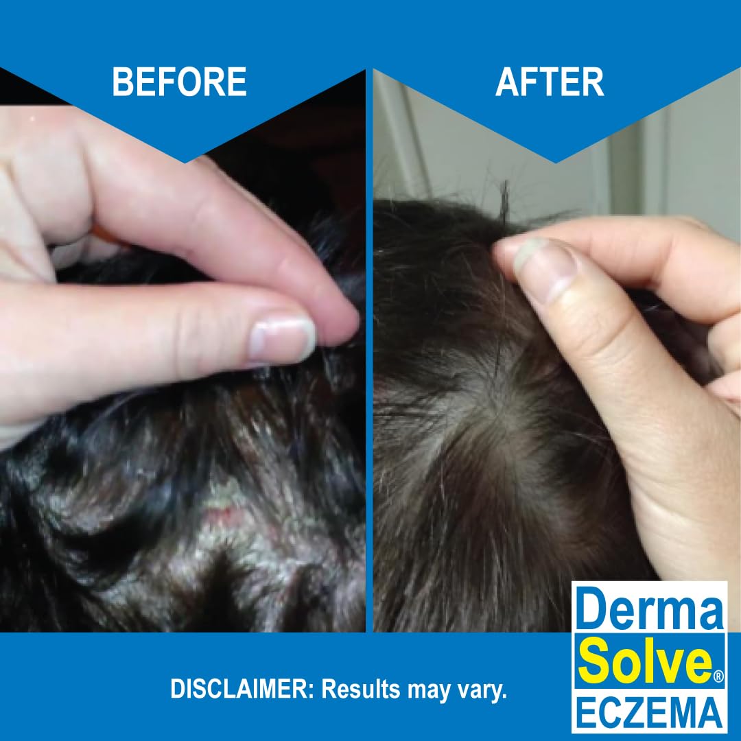 Dermasolve Eczema Relief Shampoo - 2-Pack | Gentle, Fragrance-Free, Non-Steroidal