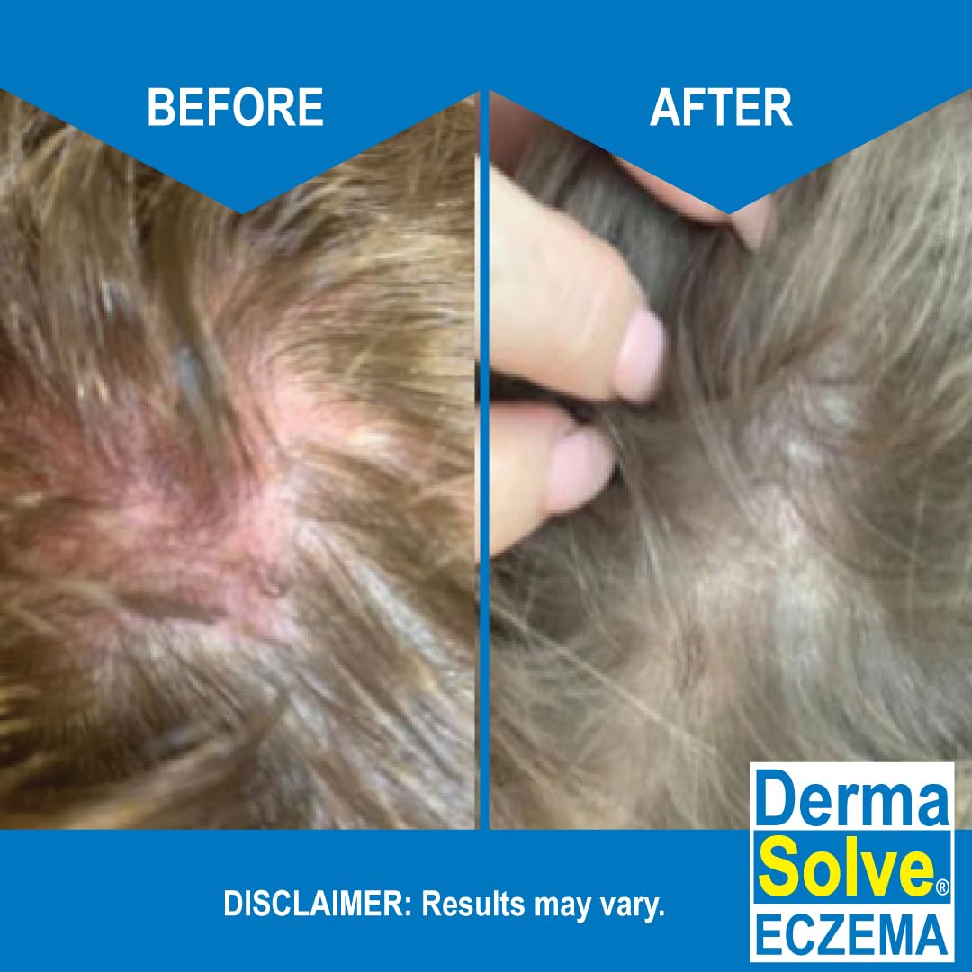 Dermasolve Eczema Relief Shampoo - 2-Pack | Gentle, Fragrance-Free, Non-Steroidal
