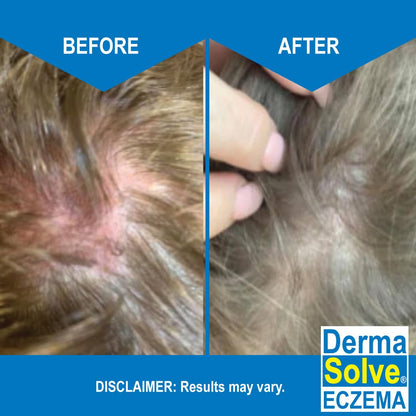 Dermasolve Eczema Shampoo & Conditioner Combo Pack – Steroid-Free for Kids & Adults