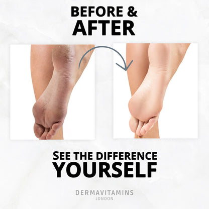 Dermavitamins Advanced Foot Mask Bag - Repairs Dry Feet Treatments (Peeling - Moisturising - Exfoliating)