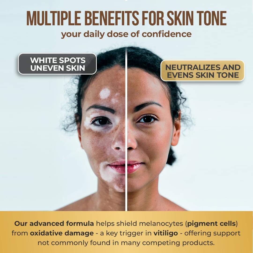 Dermawonder Vitiligo Capsules (60 Count) – Improve Skin Pigmentation & Reduce White Spots