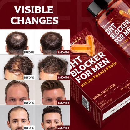 DHT Blocker for Men | Hair Growth Supplement with Saw Palmetto & Biotin | Hair Growth Vitamins